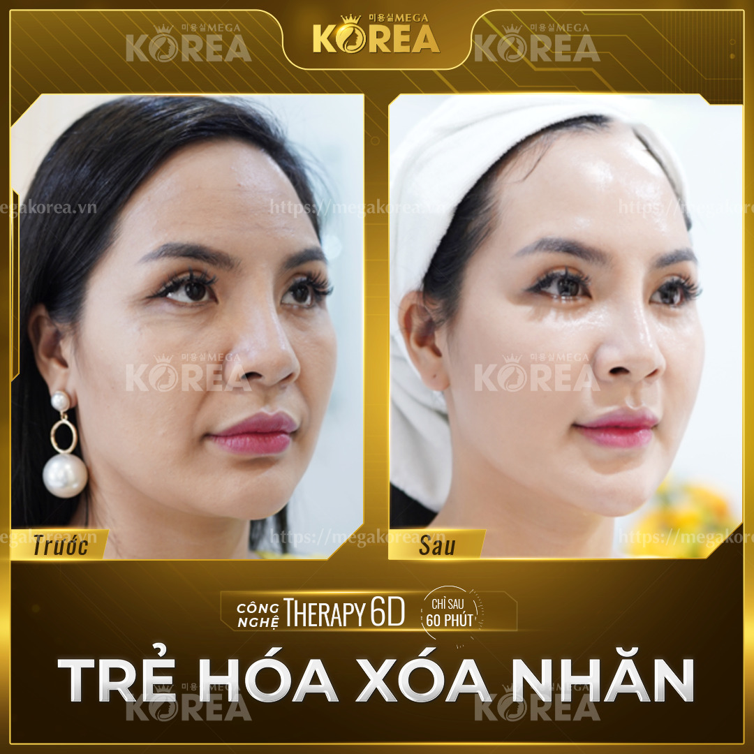 Hình ảnh khách hàng xoá nếp nhăn công nghệ Therapy 6D tại Mega Korea