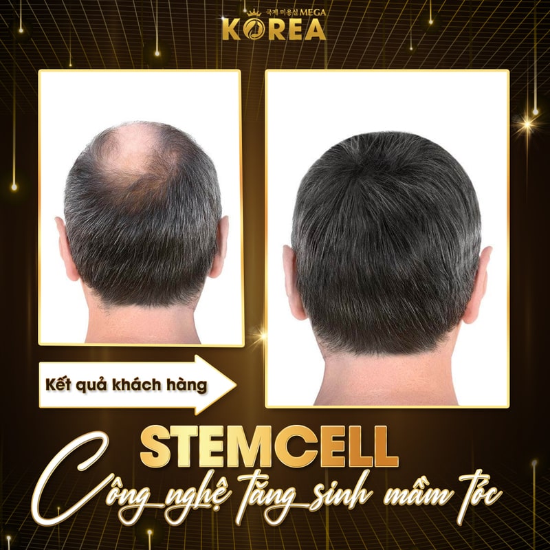 Tăng sinh mầm tóc stem cell
